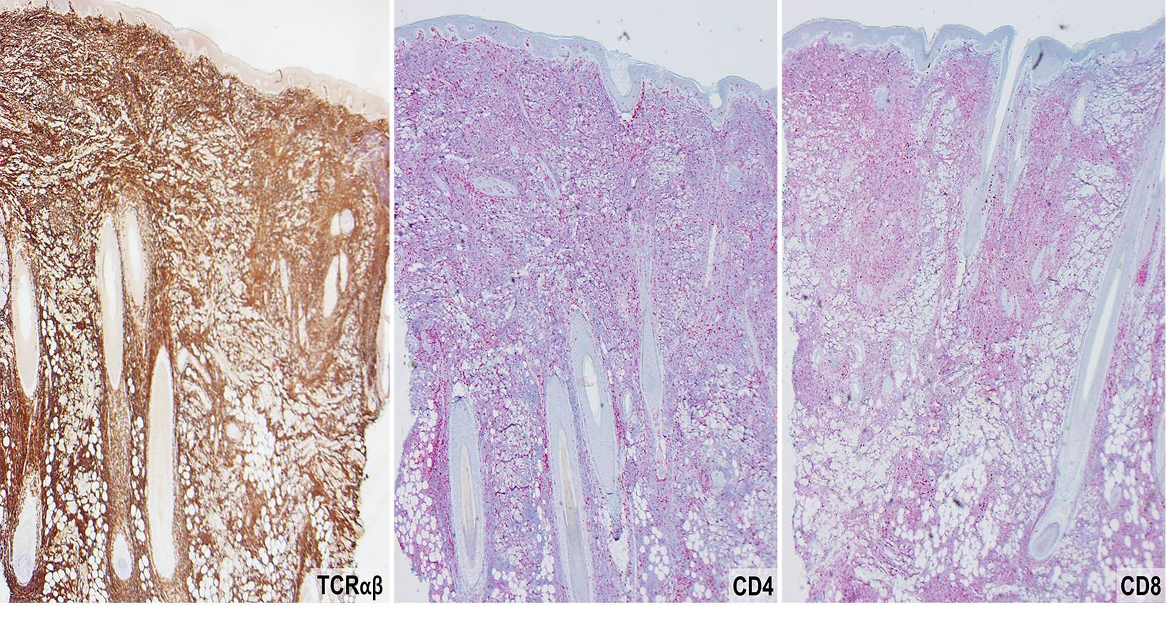 Slide 5: Figure 5. The neoplastic cells show alpha-beta T-cell lineage and predominantly express CD8, with weaker CD4 expression and a subset of CD4/CD8 double-positive cells (40×).