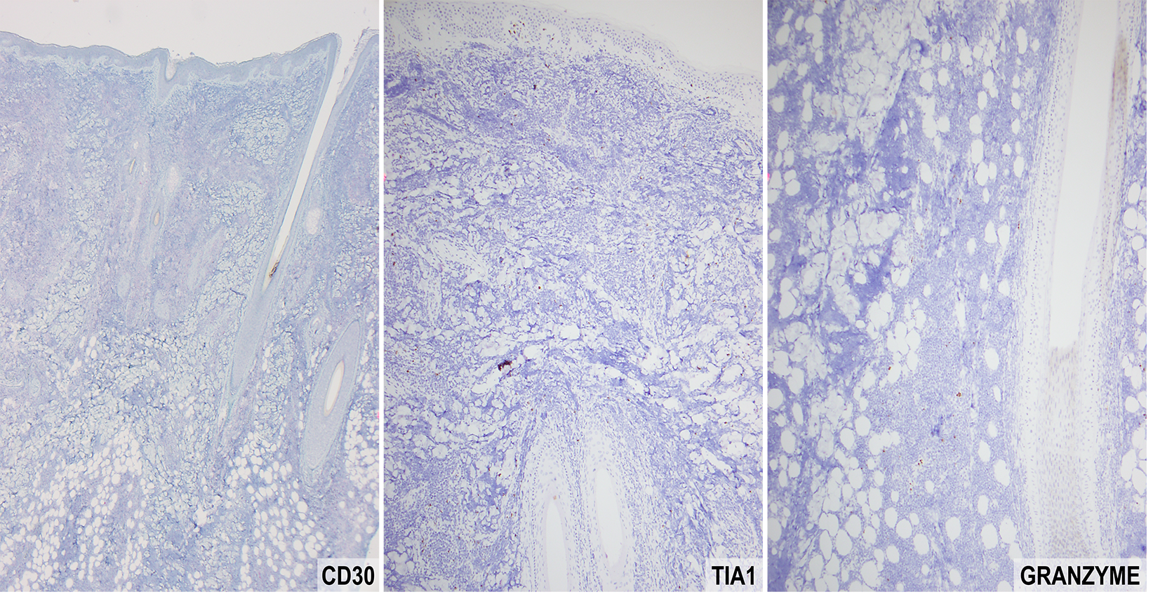 Slide 6: Figure 6. The neoplastic cells are negative for CD30 and TIA1, with only rare scattered granzyme-positive cells (40×, 40× and 100×, respectively).