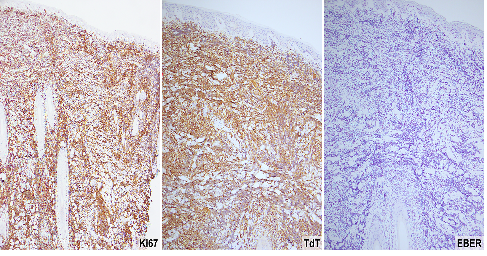 Slide 7: Figure 7. Ki-67 proliferation index is very high, exceeding 90% (40×). TdT is diffusely positive, supporting lymphoblastic differentiation (100×). EBER is negative (100×).