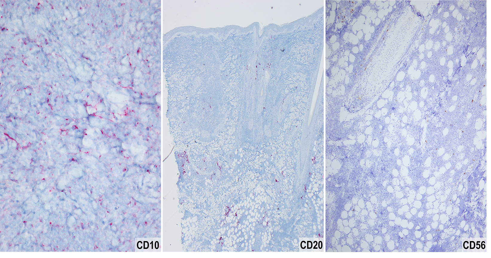 Slide 8: Figure 8. CD10 highlights a subset of neoplastic cells with a predominant perinuclear/Golgi staining pattern, which, in the context of the overall immunophenotype, may support intermediate/cortical thymocyte differentiation (400×). CD20 and CD56 are negative (40× and 100×, respectively). Subsequent CD1a staining was negative, and additional clinical workup revealed an anterior mediastinal mass, supporting systemic T-cell lymphoblastic lymphoma/leukemia.
