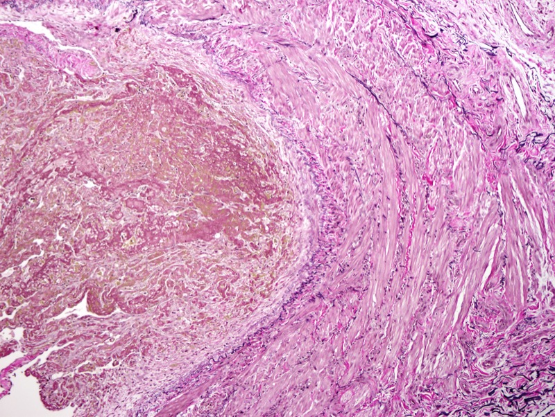 Slide 4: An Elastic tissue stain confirms the venous nature of the thrombosed and inflamed vessels.   In particular while there is some highlighting of an internal elastic lamina very key in establishing the fact that it is a vein and not an artery is the presence throughout the wall of Elastic tissue.  In particular, in between the smooth muscle cell there are elastic fibers.