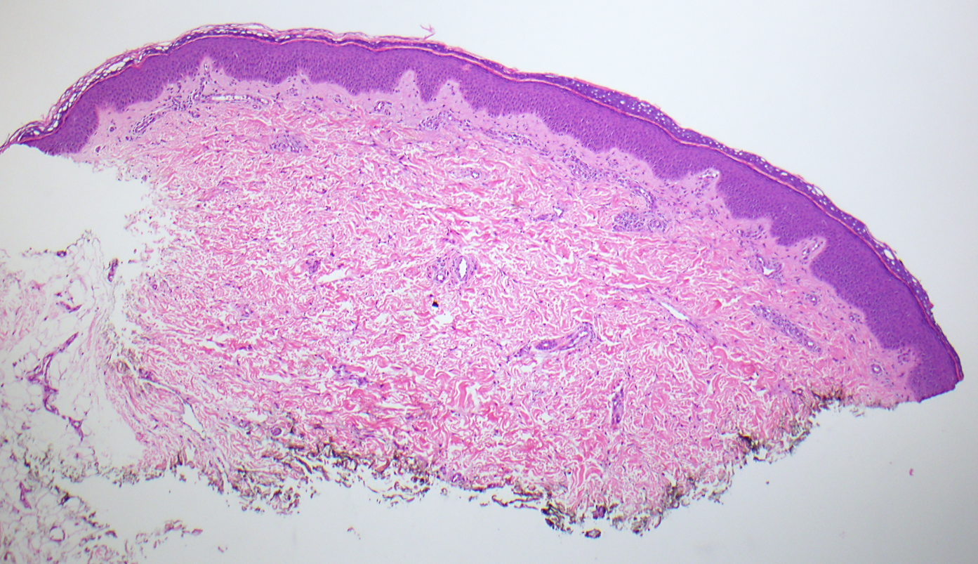 Slide 1: Figure 1. 10-year-old girl with a 7-month history of an itchy, annular, scaly plaque on left anteromedial foot measuring 7 cm (20×).