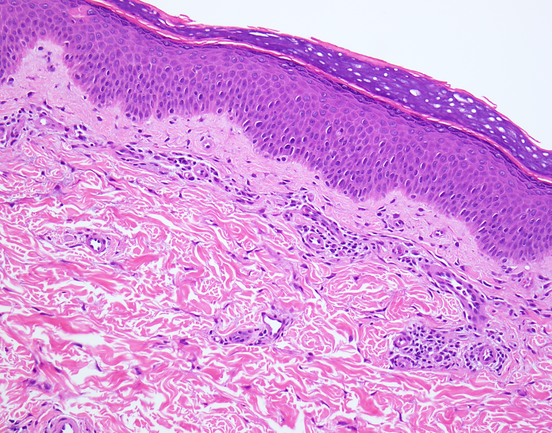 Slide 3: Figure 3. H&E shows mild epidermal acanthosis and hyperkeratosis with a modest superficial perivascular lymphocytic infiltrate in the dermis. No neutrophils are identified within the stratum corneum (200×).