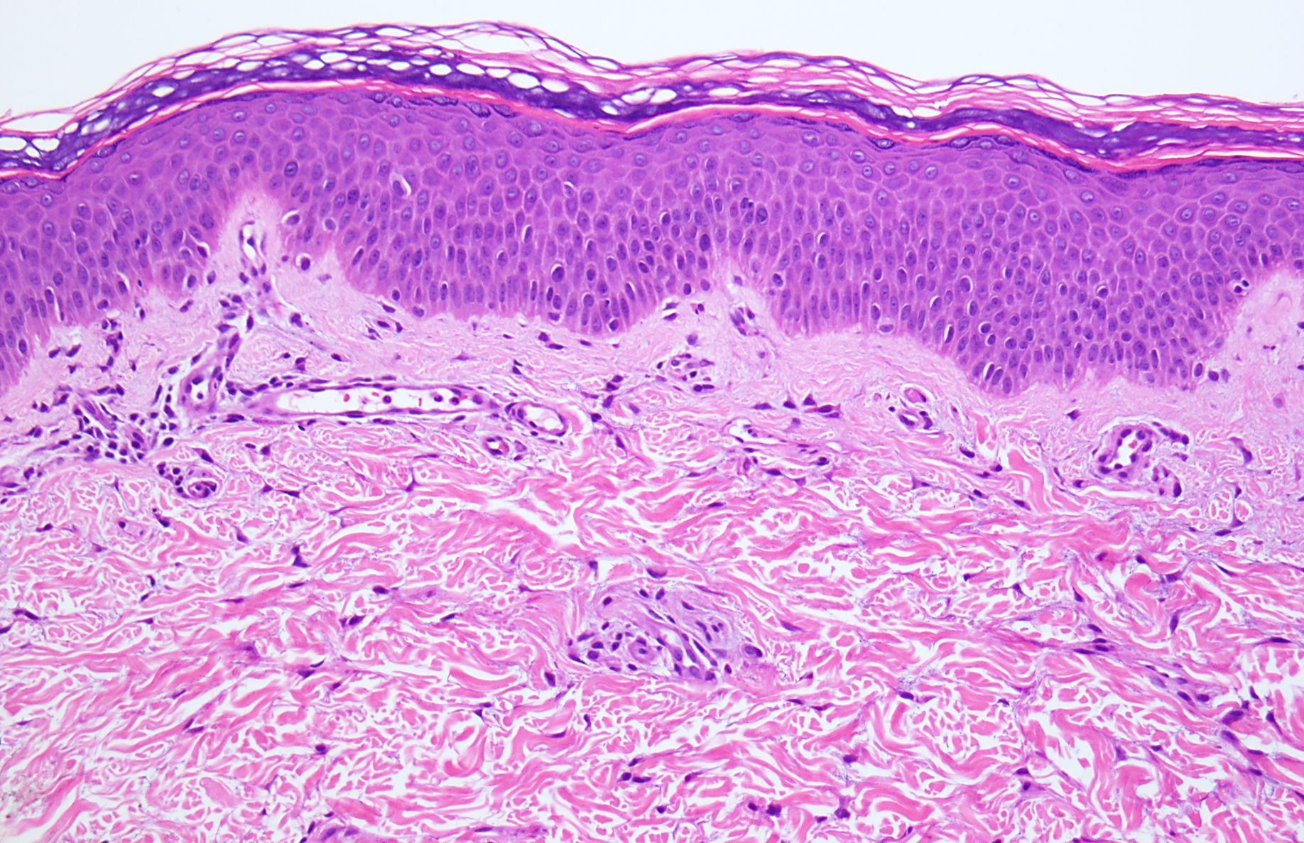 Slide 4: Figure 4. H&E shows mild epidermal acanthosis and hyperkeratosis with a modest superficial perivascular lymphocytic infiltrate in the dermis. No neutrophils are identified within the stratum corneum (200×).
