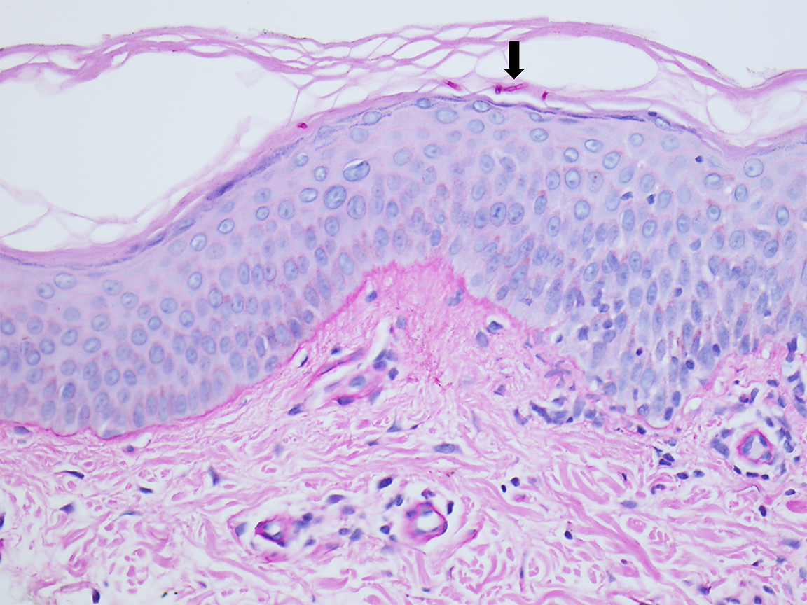 Slide 5: Figure 5. PAS stain highlights multiple septate fungal hyphae within the stratum corneum (arrow) (400×).