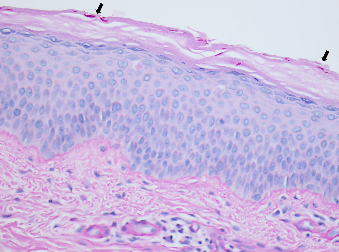 Slide 6: Figure 6. PAS stain highlights multiple septate fungal hyphae within the stratum corneum (arrows) (400×).