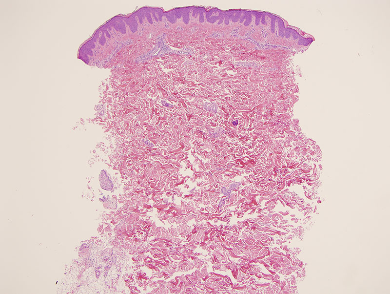 Slide 1: The patient carries a diagnosis of atopic dermatitis and ichthyosis vulgaris. There are certain aspects of the biopsy that could be construed as atopic dermatitis-like in terms of the mild epidermal hyperplasia and parakeratosis with the perivenular lymphocytic infiltrate.