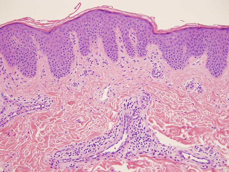 Slide 2: The patient carries a diagnosis of atopic dermatitis and ichthyosis vulgaris. There are certain aspects of the biopsy that could be construed as atopic dermatitis-like in terms of the mild epidermal hyperplasia and parakeratosis with the perivenular lymphocytic infiltrate.