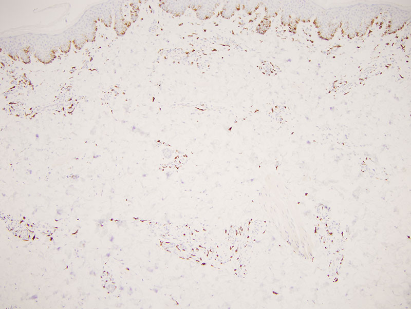 Slide 4: The CD117 preparation highlights the many mast cells that are present in this biopsy. The mast cells are accentuated around vessels, nerves and the eccrine coil on this stain corresponding to the distribution that is apparent on routine light microscopy.