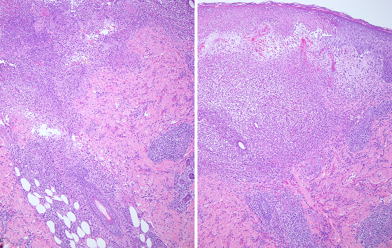 Slide 2: Figure 2. H&E shows folliculocentric neutrophilic dermolysis with striking undermining of the interfollicular epidermis and frank epidermal necrosis (100×).