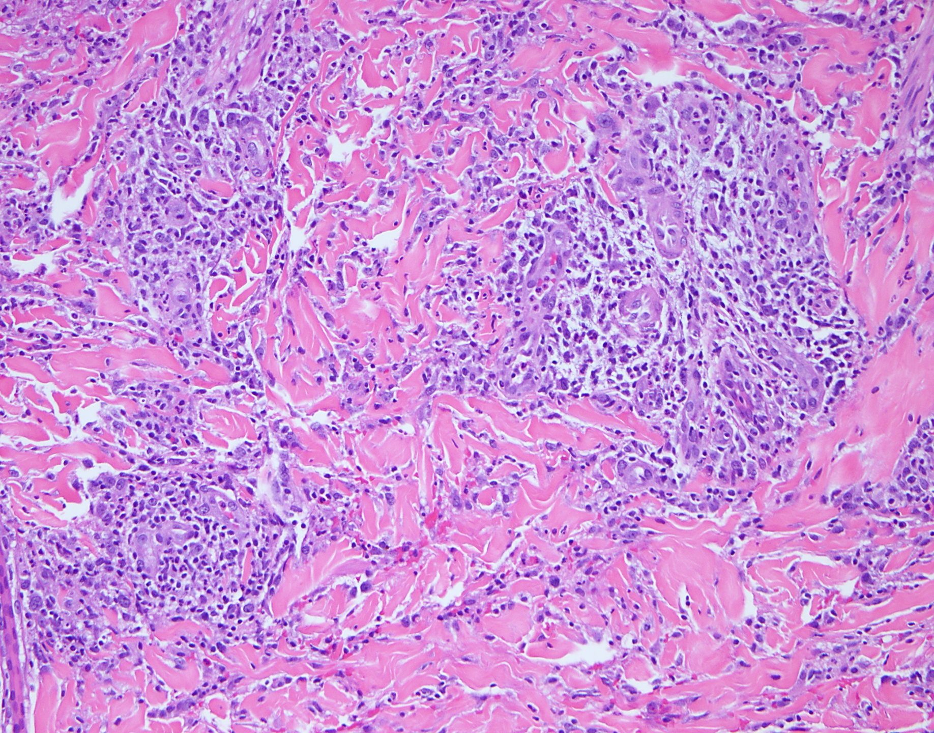 Slide 3: Figure 3. H&E shows angiocentric neutrophilic and mononuclear inflammation with mural and luminal fibrin deposition. These vasculitic changes are largely confined to zones of neutrophilic dermolysis and are interpreted as secondary vascular injury rather than the primary driver of the process (200×).
