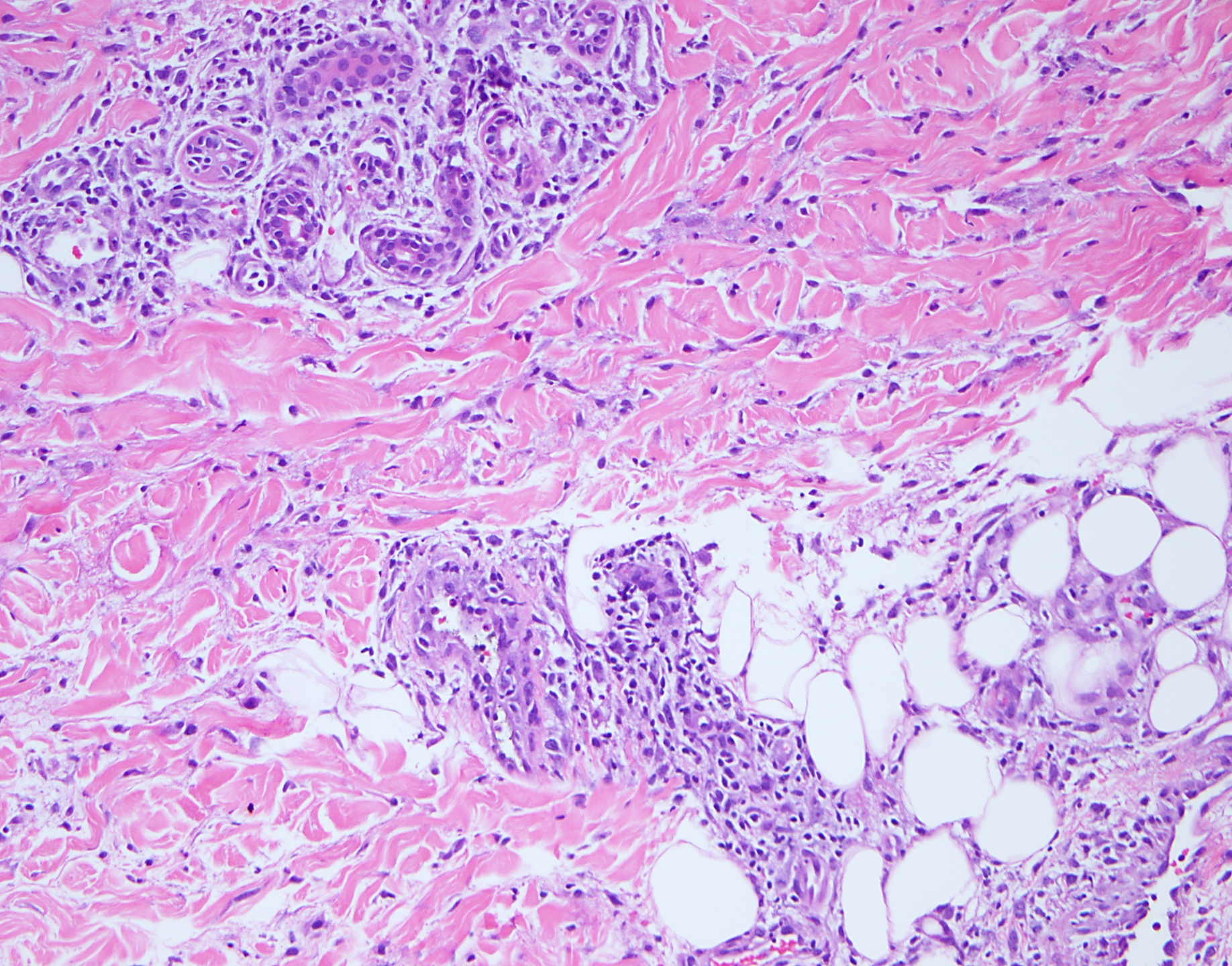 Slide 4: Figure 4. Away from the zone of necrotizing neutrophilic dermolysis, H&E shows a lymphomononuclear infiltrate with a minor neutrophilic component, accentuated around nerves and blood vessels and extending into the adventitial dermis and fat (200×).