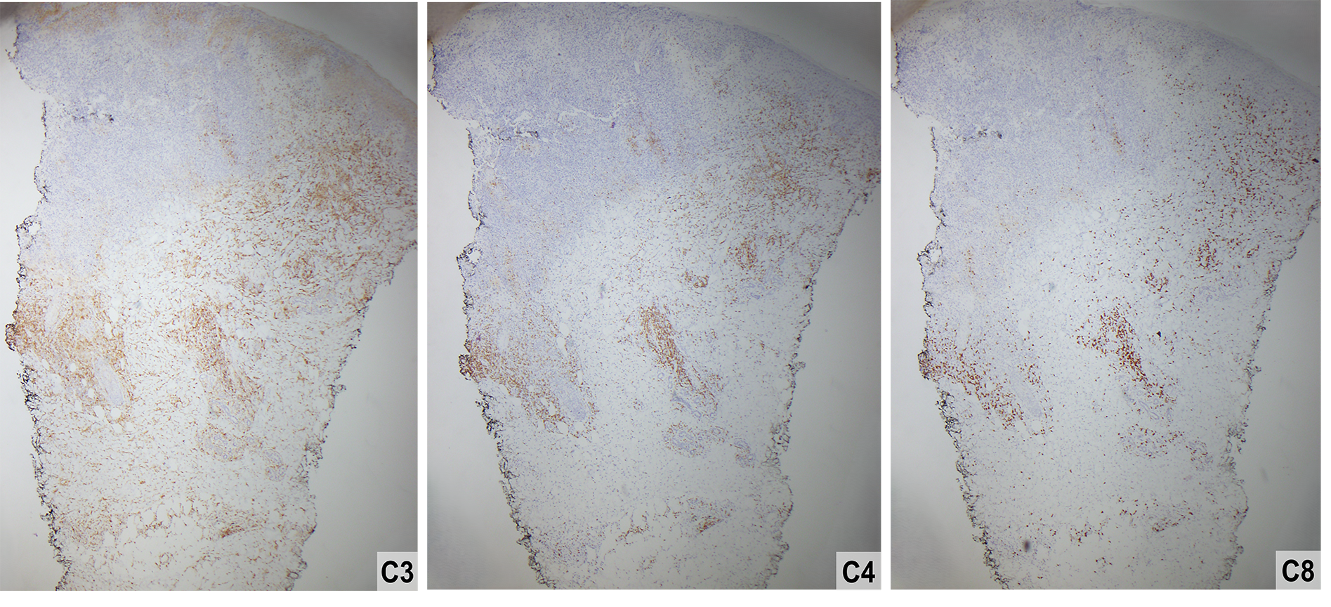Slide 5: Figure 5. CD3, CD4, and CD8 immunohistochemistry highlight the T-cell component of the infiltrate, with predominance of CD4-positive cells over CD8-positive cells (40×).