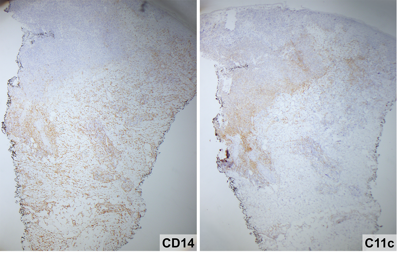 Slide 6: Figure 6. CD14 and CD11c immunohistochemistry highlight monocytes and monocyte-derived dendritic cells, respectively, supporting a mixed monocyte/T-cell infiltrate likely contributing to secondary neutrophil recruitment (40×).